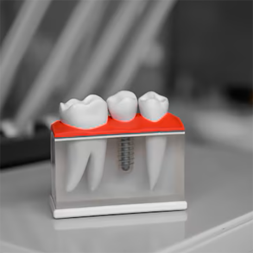 crowns-bidges crowns-bidges