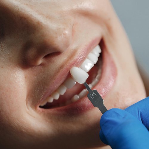 dental-iImplants dental-iImplants