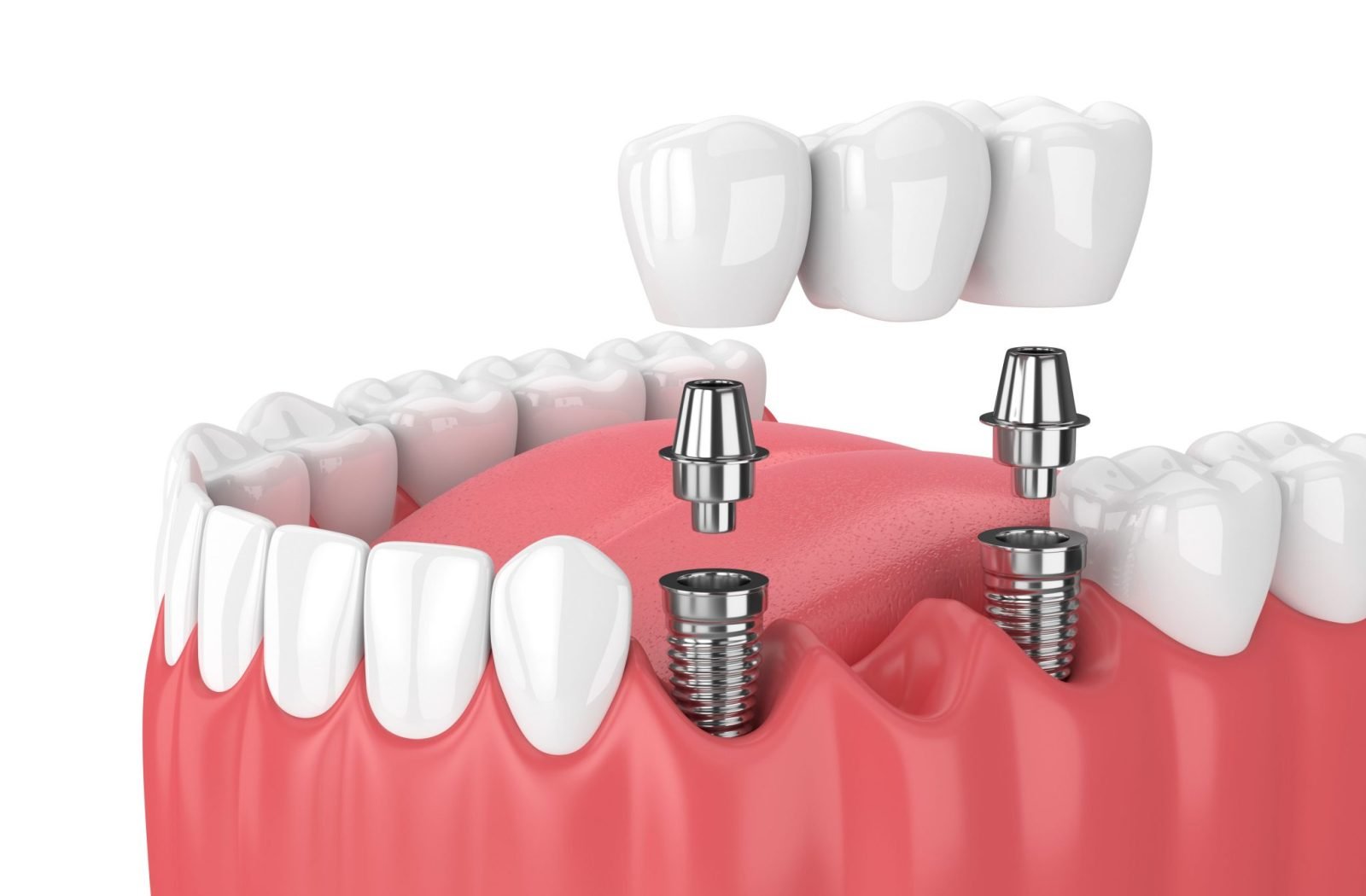 Dental-Implant-Feat-2-scaled