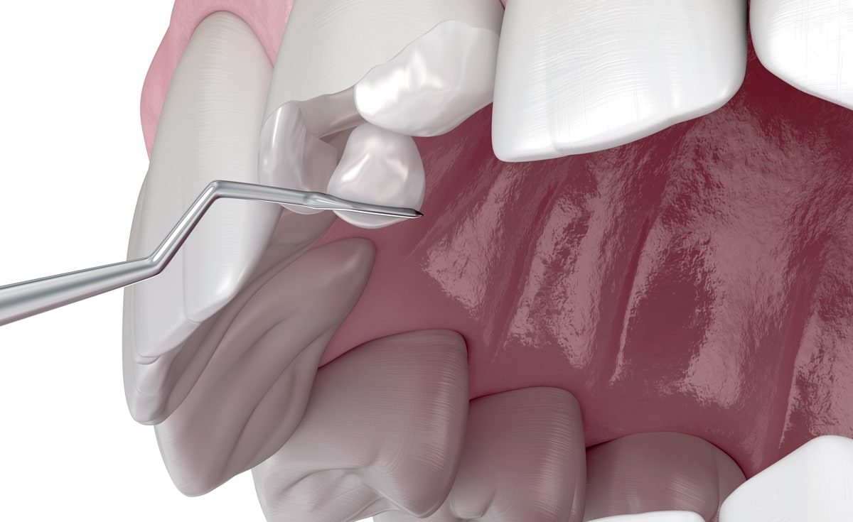 Kunststofffuellungen-optimale-Loesung-Frontzahnbereich