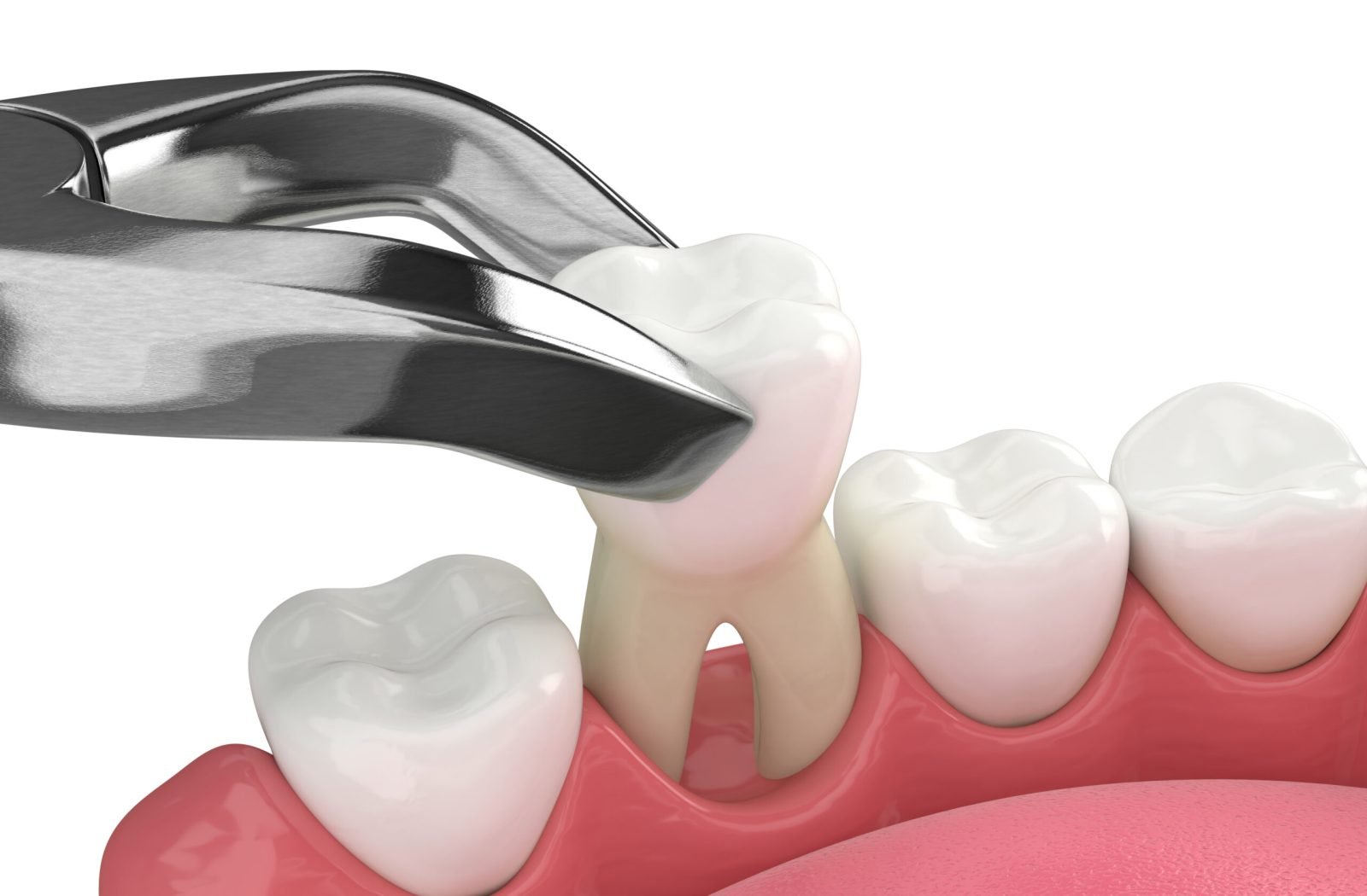 3d render of lower jaw with tooth extracted by dental forceps